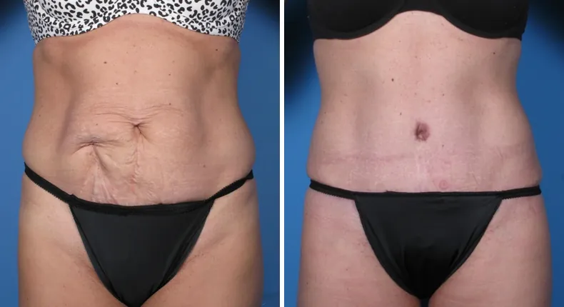 Before and after tummy tuck: woman's abdomen from the front