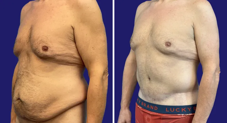 Before and after tummy tuck: man's abdomen, with liposuction and body lift
