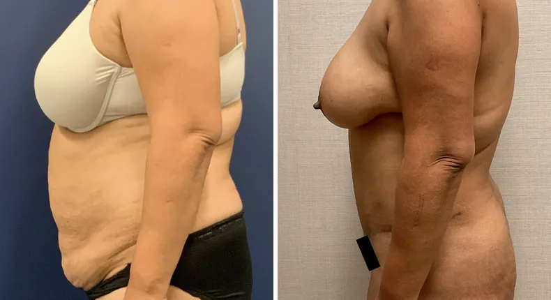 Before and after tummy tuck: patient's abdomen from the left side, with liposuction