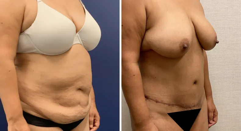 Before and after tummy tuck: patient's abdomen at a right angle, with liposuction