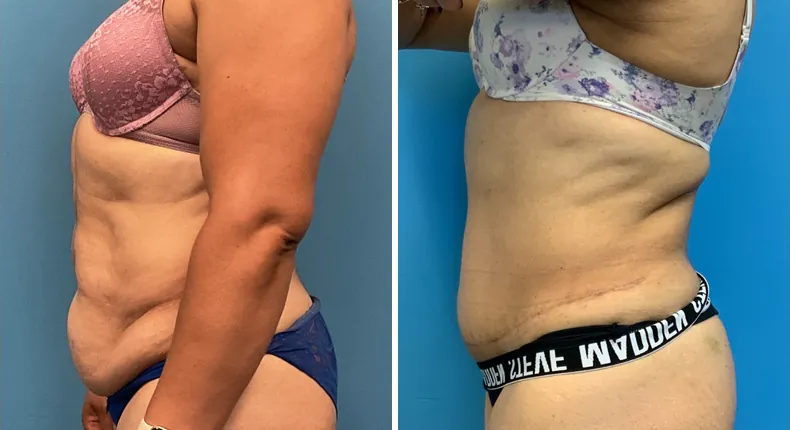 Before and after tummy tuck: patient's abdomen from the left side