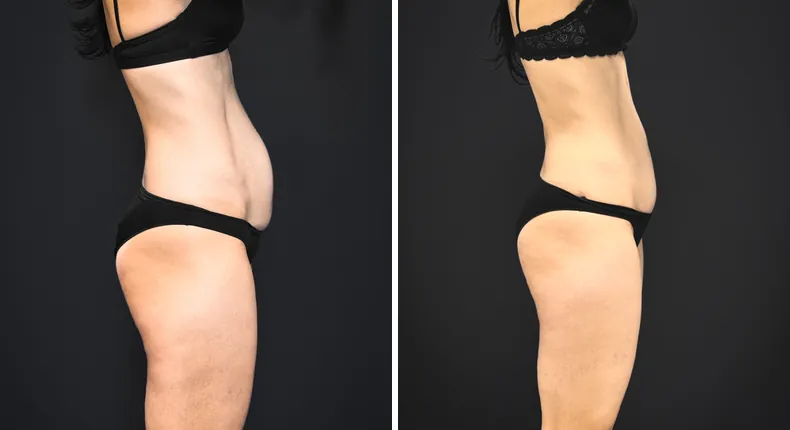 Before and after tummy tuck: patient's abdomen from the right side