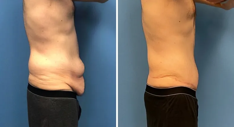 Before and after tummy tuck: patient's abdomen from the right side, with body lift