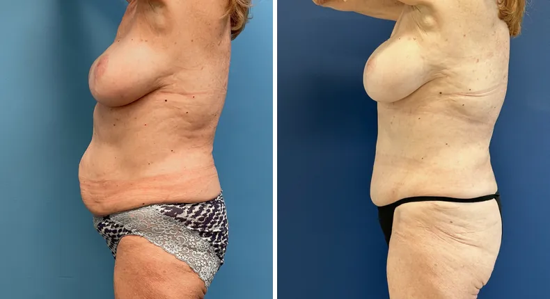 Before and after tummy tuck: patient's abdomen from the left side, with liposuction