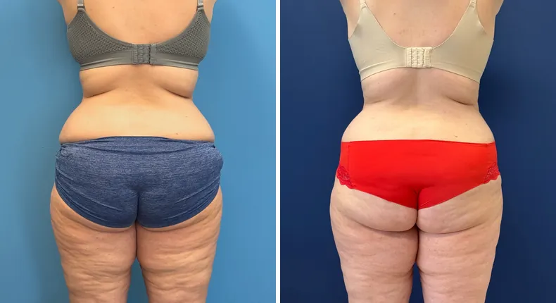 Before and after tummy tuck: patient's abdomen from the back