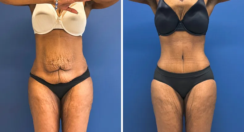 Before and after tummy tuck: patient's abdomen from the front