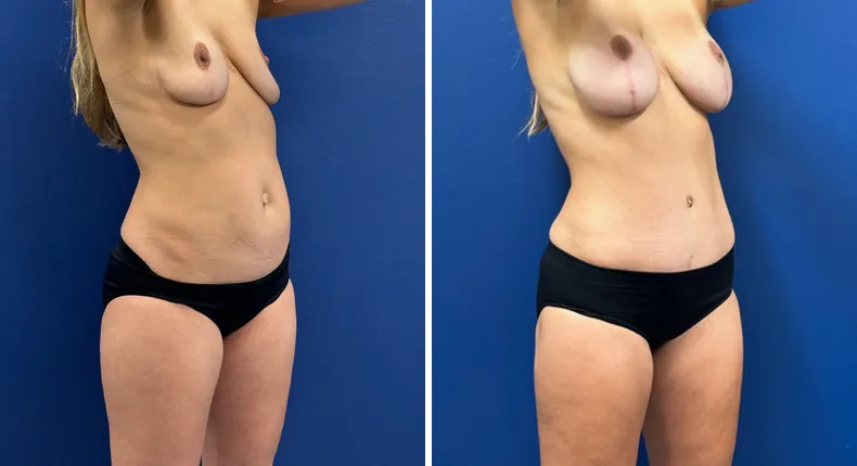 Before and after tummy tuck: patient's abdomen at a right angle, with breast augmentation with lift and liposuction