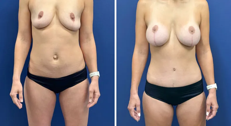 Before and after tummy tuck: patient's abdomen from the front, with breast augmentation with lift and liposuction