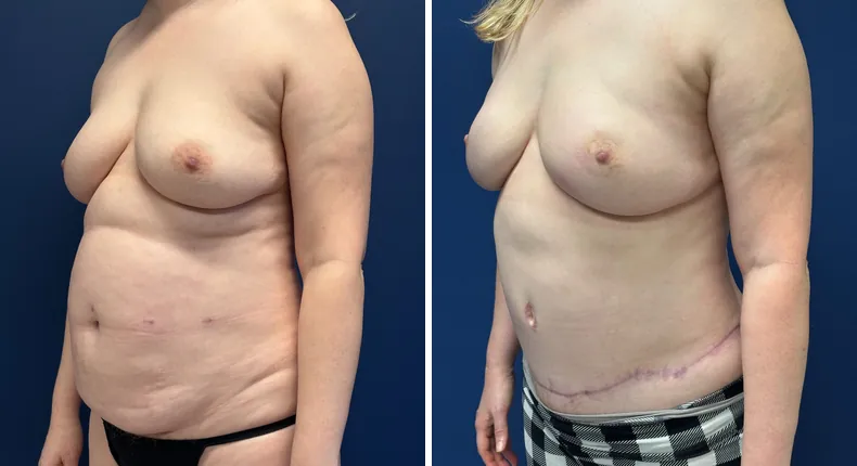 Before and after tummy tuck: woman's abdomen at a left angle, with liposuction and breast reconstruction