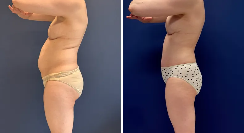 Before and after tummy tuck: patient's abdomen