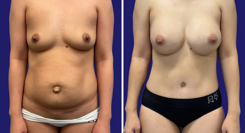 Before and after tummy tuck: woman's abdomen, with breast augmentation, liposuction and mommy makeover