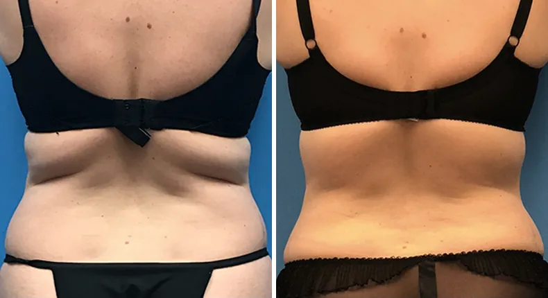 Before and after tummy tuck: woman's abdomen from the back, with liposuction