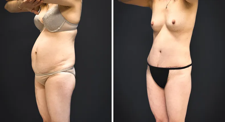 Before and after tummy tuck: patient's abdomen from the left side