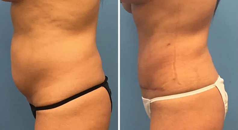 Before and after tummy tuck: woman's abdomen from the left side, with liposuction