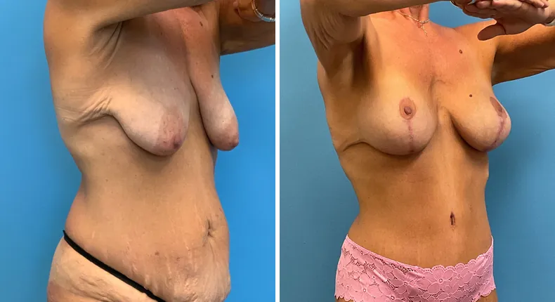 Before and after tummy tuck: patient's abdomen at a right angle