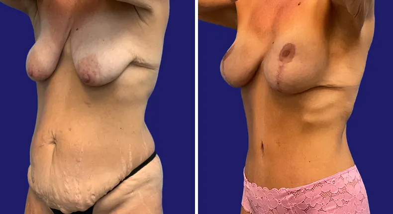 Before and after tummy tuck: woman's abdomen, with breast augmentation, breast lift, liposuction, mommy makeover and arm lift