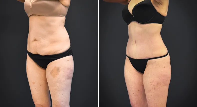 Before and after tummy tuck: patient's abdomen from the left side