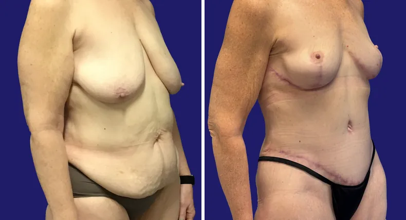 Before and after tummy tuck: woman's abdomen, with liposuction and mommy makeover