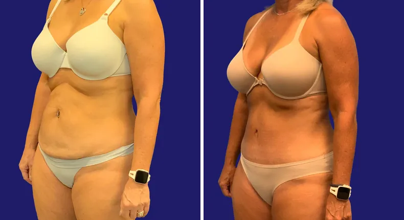 Before and after tummy tuck: woman's abdomen, with liposuction and mommy makeover