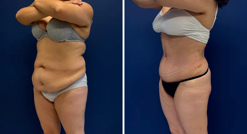 Before and after tummy tuck: patient's abdomen