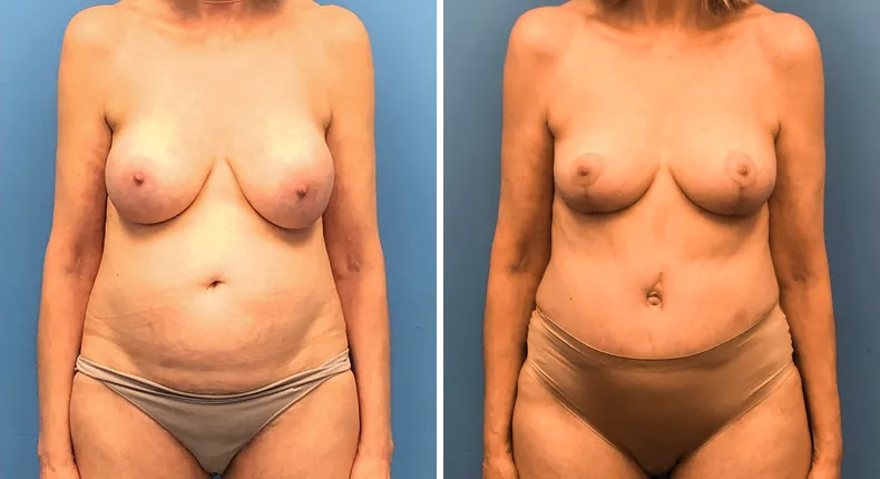 Before and after tummy tuck: patient's abdomen from the front, with breast lift and liposuction