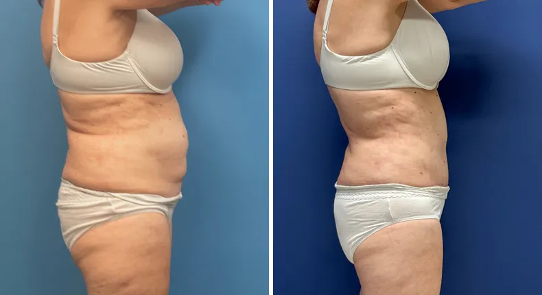 Before and after tummy tuck: patient's abdomen from the right side, with liposuction
