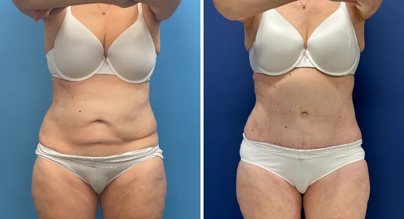 Before and after tummy tuck: patient's abdomen from the front, with liposuction