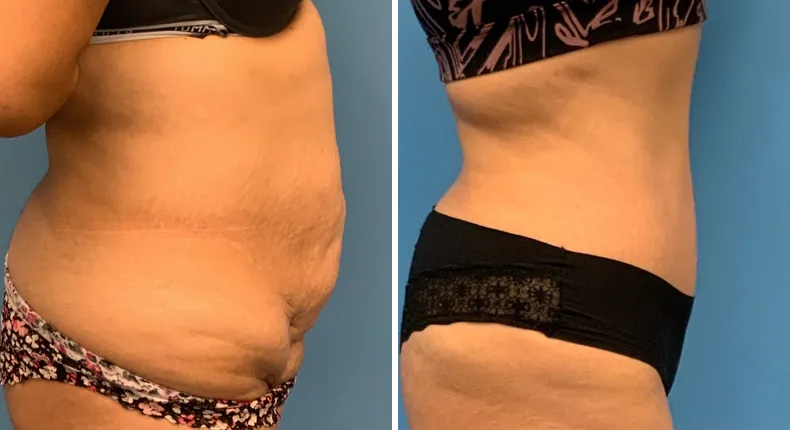 Before and after tummy tuck: patient's abdomen from the right side