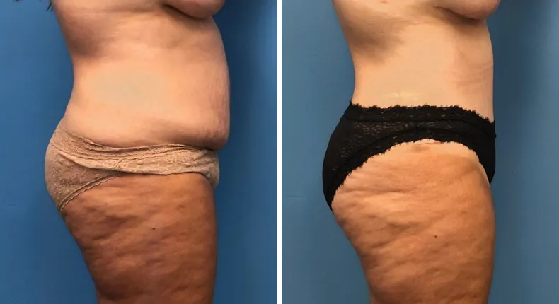 Before and after tummy tuck: woman's abdomen from the right side, with liposuction and mommy makeover