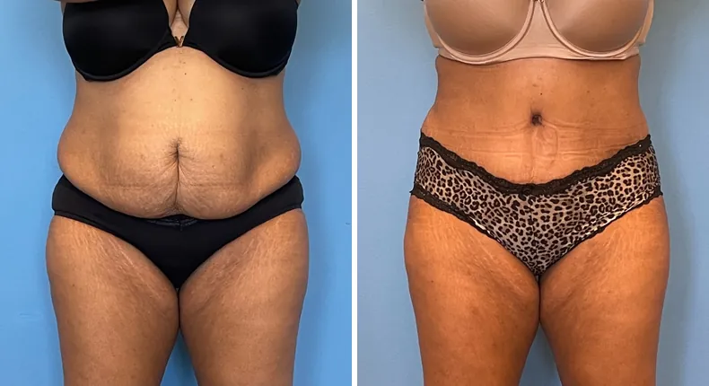 Before and after tummy tuck: patient's abdomen from the front, with liposuction