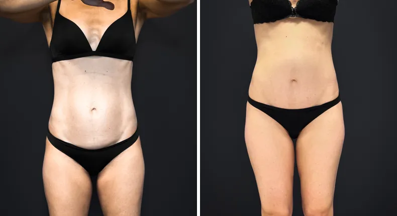 Before and after tummy tuck: patient's abdomen from the front