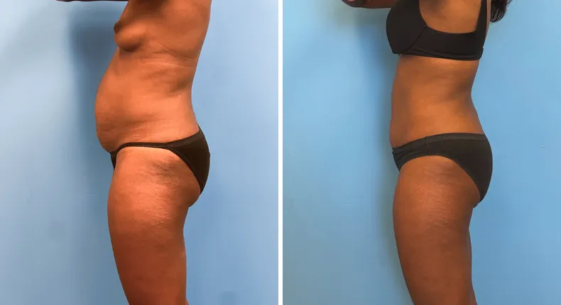 Before and after tummy tuck: patient's abdomen in left profile