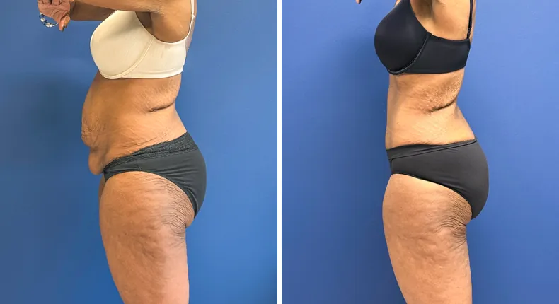 Before and after tummy tuck: patient's abdomen from the left side