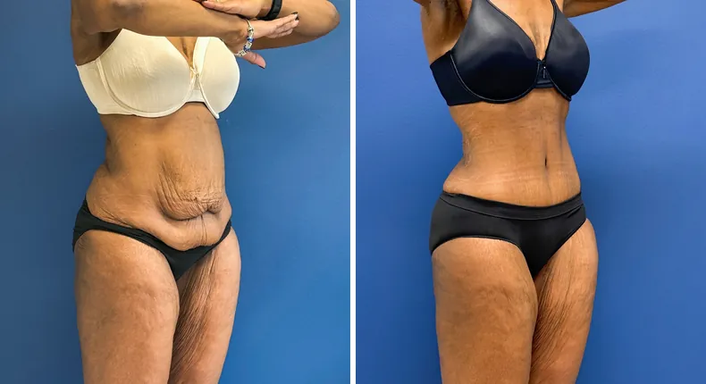 Before and after tummy tuck: patient's abdomen at a right angle