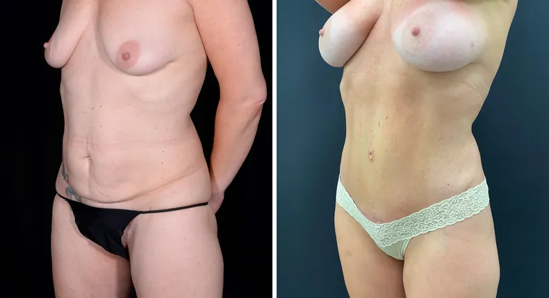 Before and after tummy tuck: patient's abdomen at a left angle, with breast augmentation