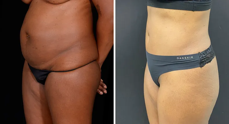 Before and after tummy tuck: patient's abdomen at a left angle