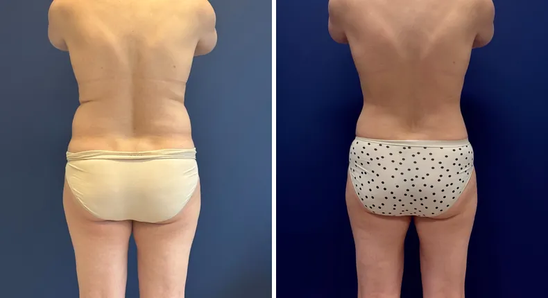 Before and after tummy tuck: patient's abdomen