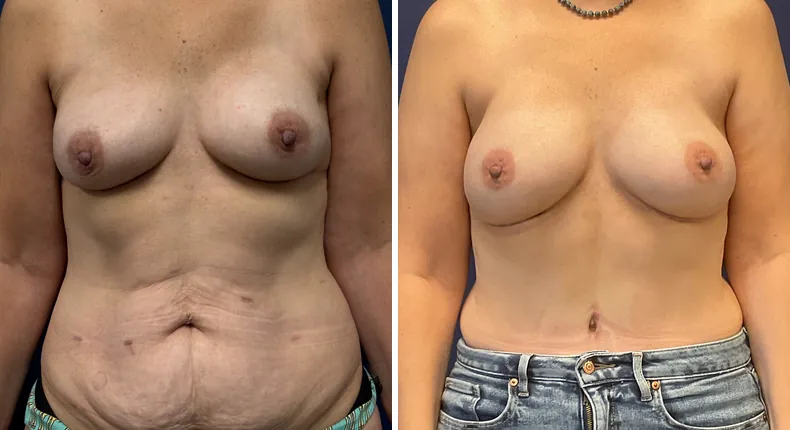 Before and after tummy tuck: patient's abdomen, with diep flap