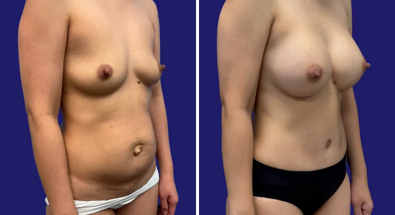 Before and after tummy tuck: woman's abdomen, with breast augmentation, liposuction and mommy makeover