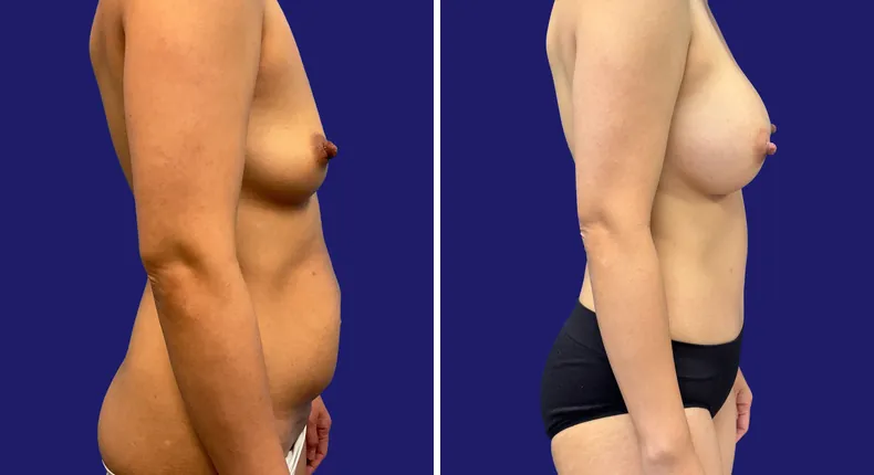 Before and after tummy tuck: woman's abdomen, with breast augmentation, liposuction and mommy makeover