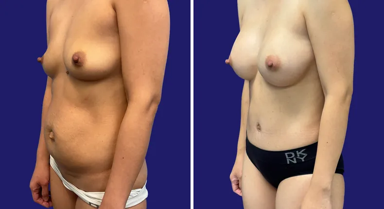 Before and after tummy tuck: woman's abdomen, with breast augmentation, liposuction and mommy makeover