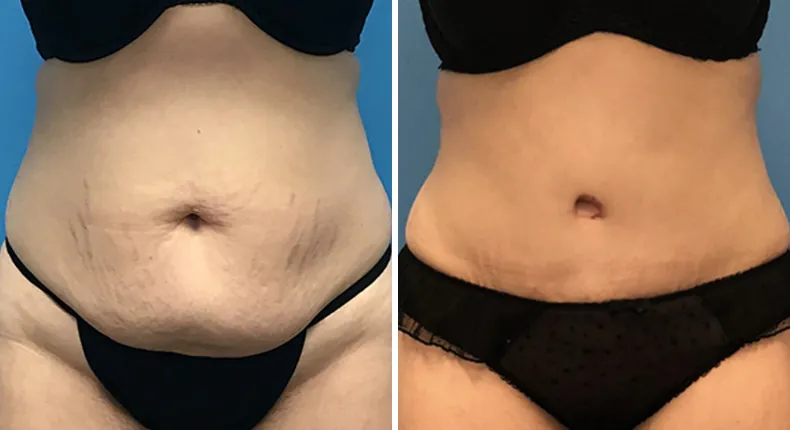 Before and after tummy tuck: woman's abdomen from the front, with liposuction