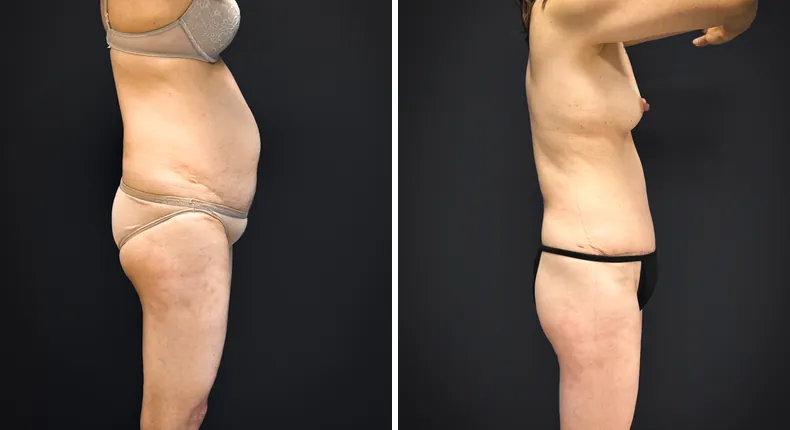 Before and after tummy tuck: patient's abdomen from the right side