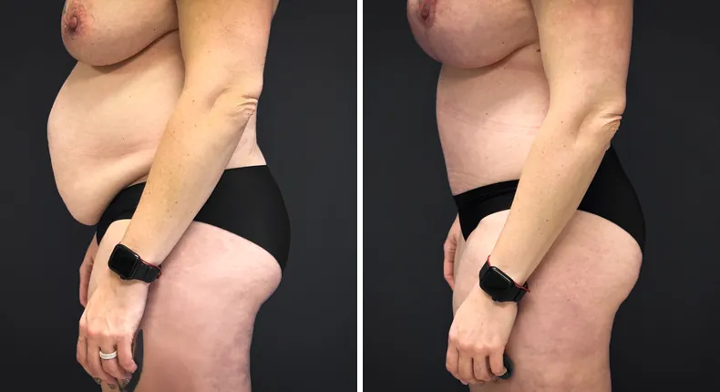 Before and after tummy tuck: patient's abdomen from the right side, with liposuction