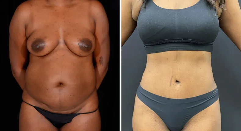 Before and after tummy tuck: patient's abdomen from the front, with liposuction