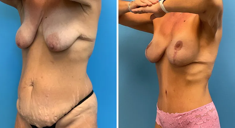 Before and after tummy tuck: patient's abdomen at a left angle