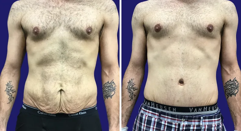 Before and after tummy tuck: man's abdomen from the front, with body lift