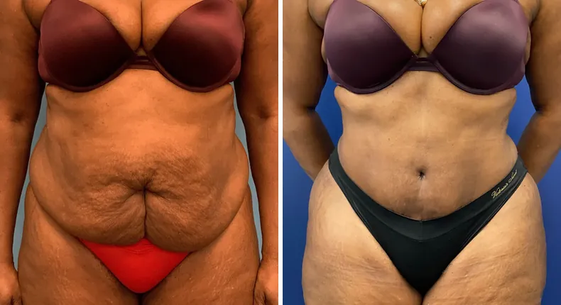 Before and after tummy tuck: patient's abdomen from the front