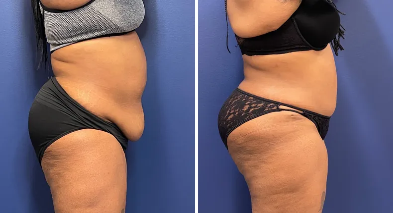 Before and after tummy tuck: patient's abdomen from the right side, with liposuction