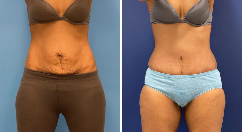 Before and after tummy tuck: patient's abdomen from the front, with liposuction